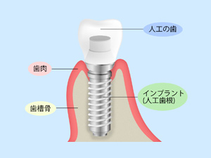 インプラント治療について