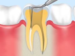 当院の根管治療